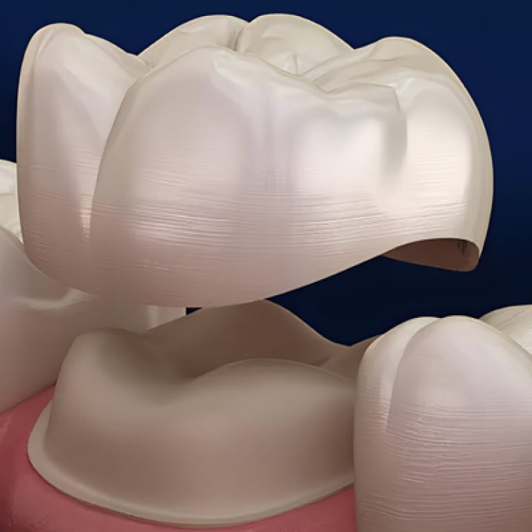 Dental-Crowns01
